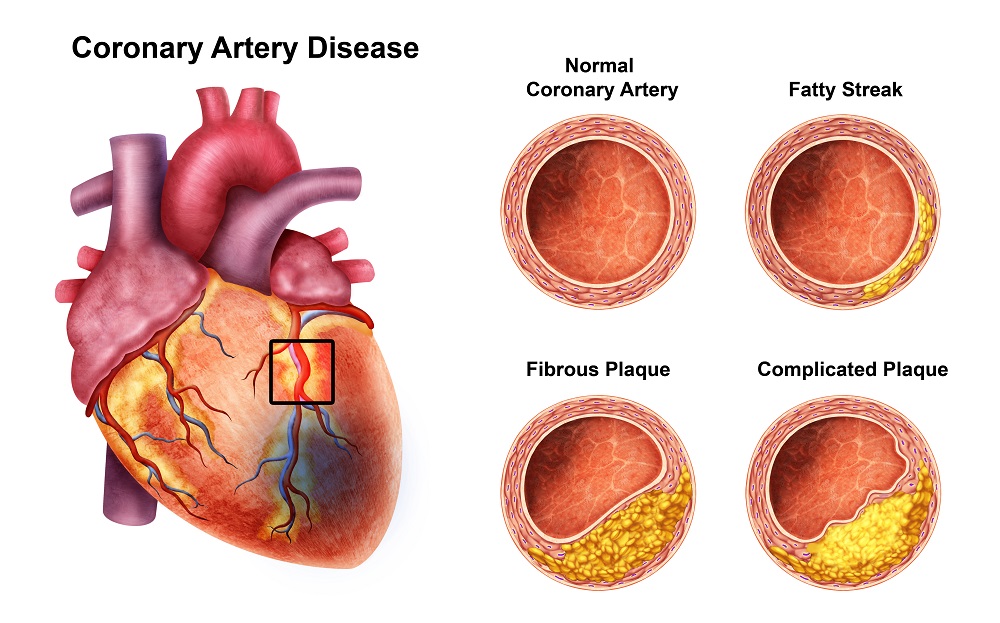 how does a fatty streak happen in arteries